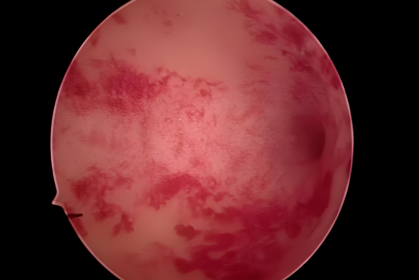 内膜炎做试管移植要放平心态