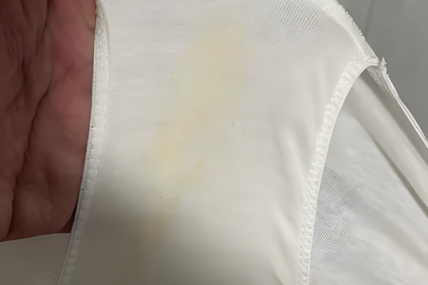 移植后白带多要谨防炎症感染