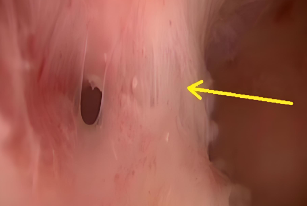 宮角粘連會阻礙胚胎著床