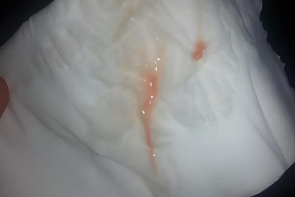 移植后出血可能是着床失败了