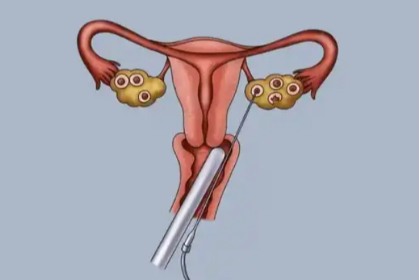 试管婴儿需要母体孕育