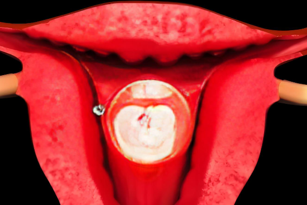 宫腔空间有限不利于双胎发育