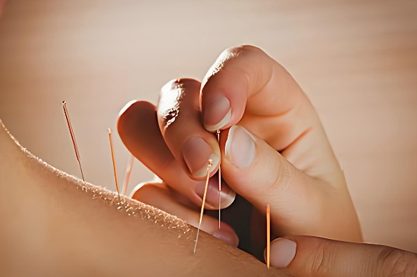 移植前針灸可改善血液循環