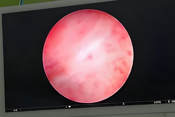 间苯三酚可改善内膜环境