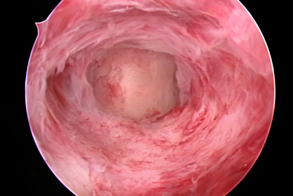 宮角粘連做試管移植容易流產