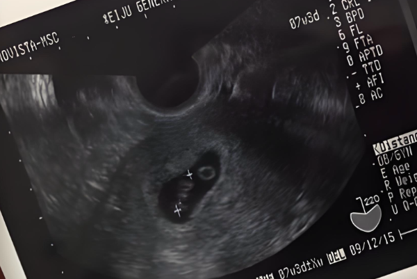 11周无胎心可能是孕周算错了